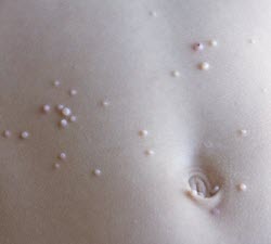 Molusco contagioso